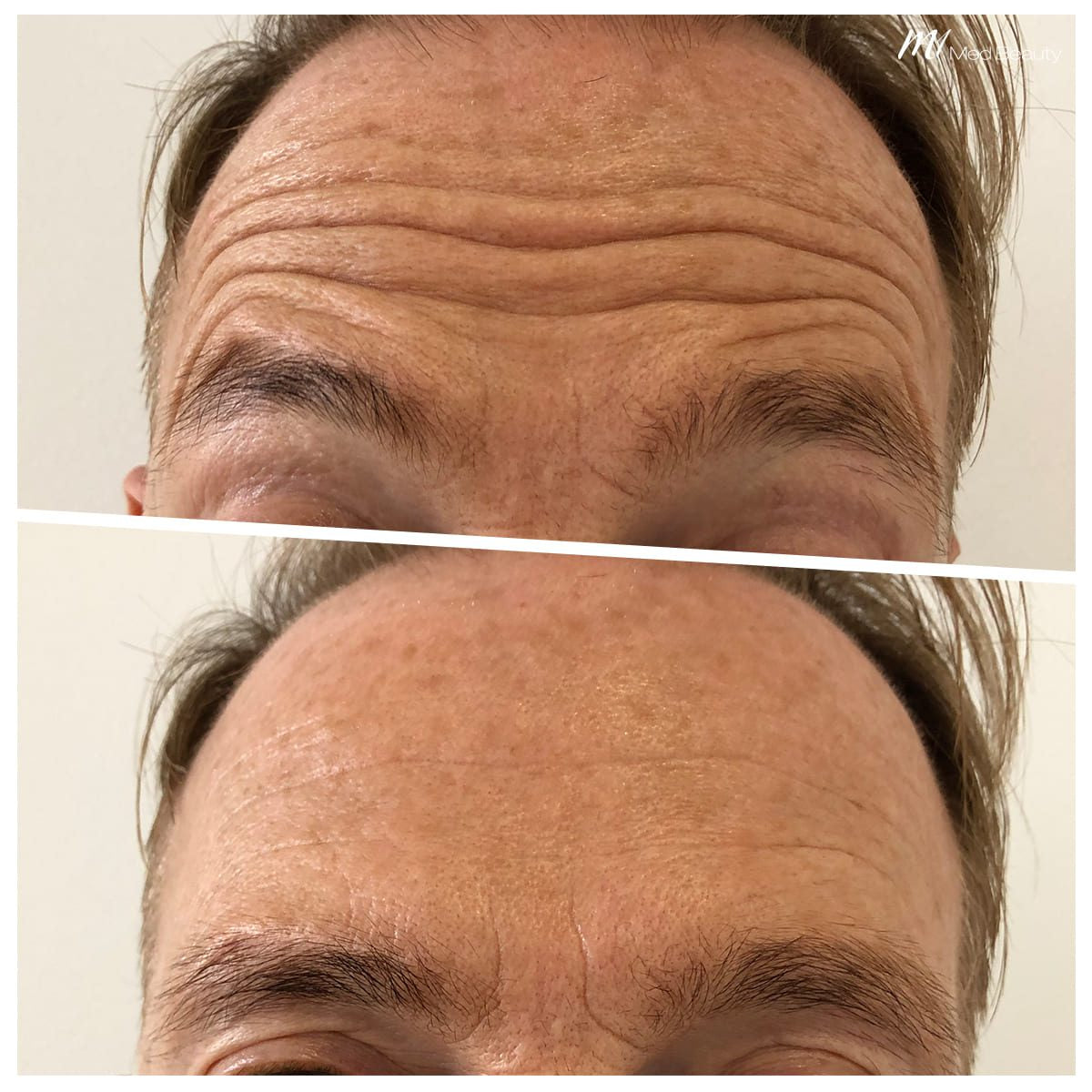 Anti Wrinkle One Area